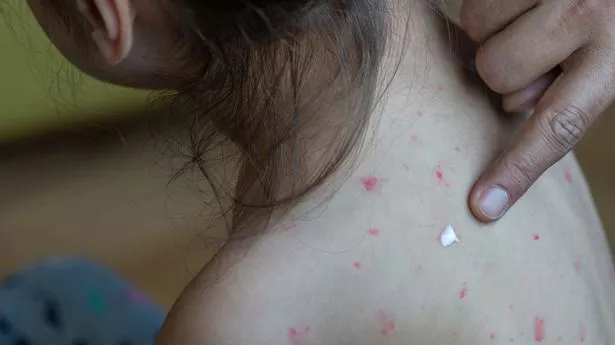 新的英国麻疹地图显示了你所在地区的病例,记录了2500例感染